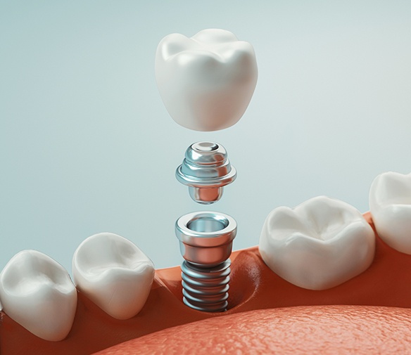 Animated dental implant placement