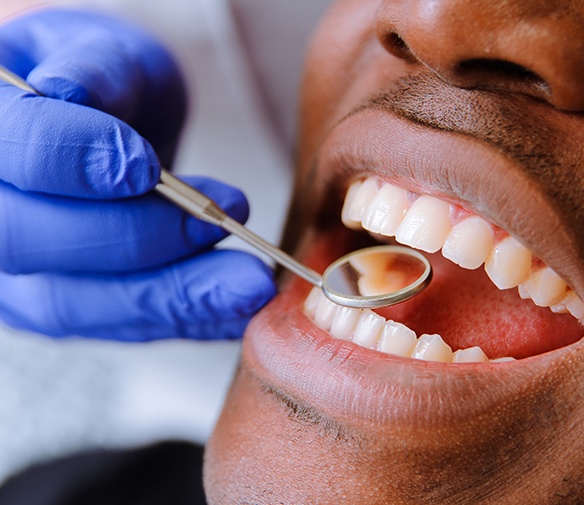 Dentist checking tooth colored filling during a restorative dentistry visit